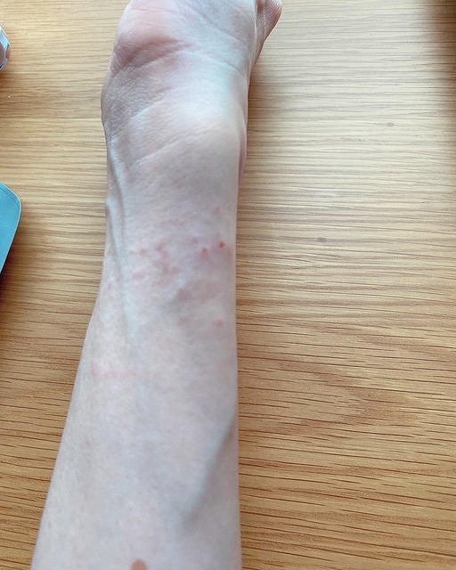 金属アレルギーに被れた腕の写真