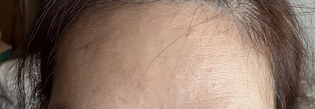 オデコのブツブツ写真