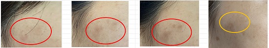 治療前から現在のシミの変化の写真